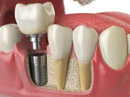 Implantar valor de cada dente 2023 amil